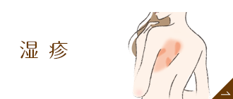 湿疹