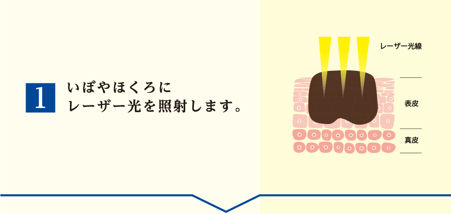 京都でホクロ除去なら京都駅前さの皮フ科クリニック | 京都駅前