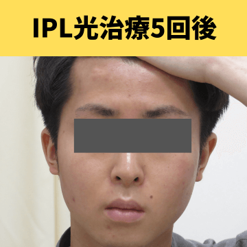 施術後