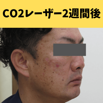 施術後