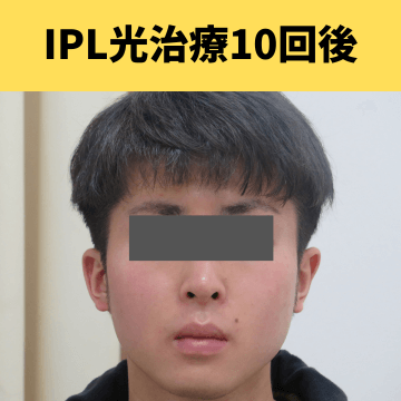 施術後