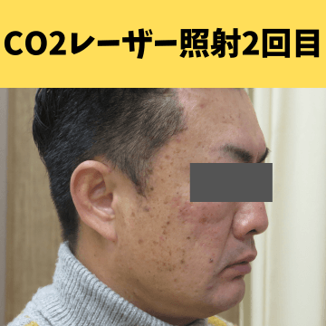施術後