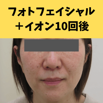 施術後