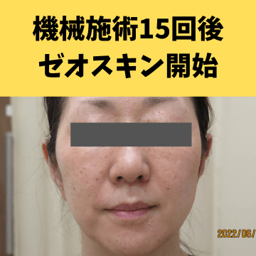 施術後