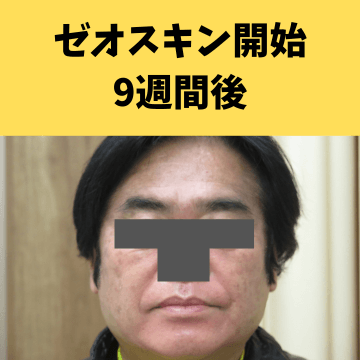 施術後