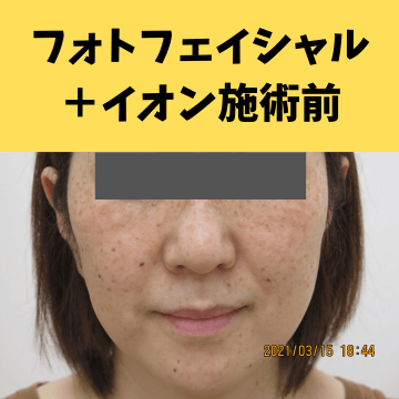 施術前