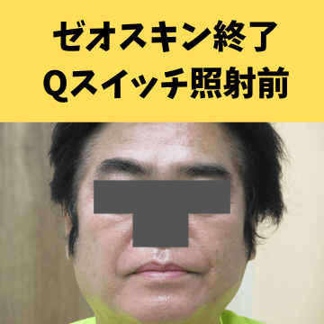 施術後