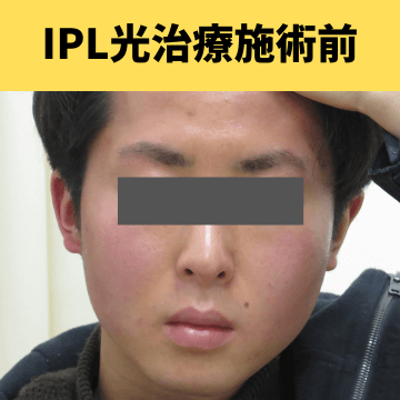 施術前