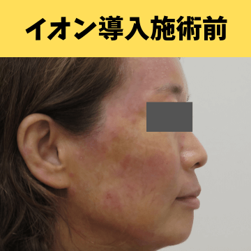 施術前