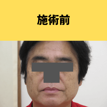 施術前